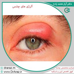 آلرژی های چشمی