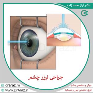 جراحی لیزر چشم