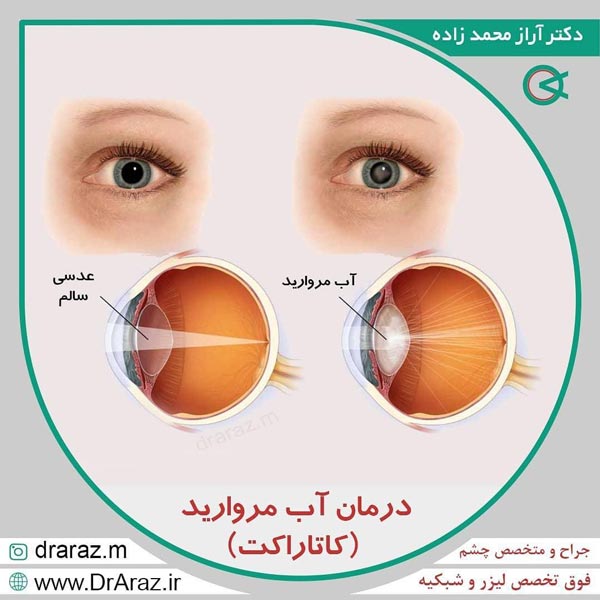 عکس آب مروارید - دکتر آراز محمدزاده