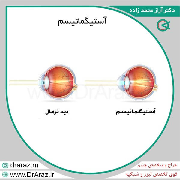 آستیگماتیسم + درمان 100% + روش های درمان دکتر آراز محمدزاده