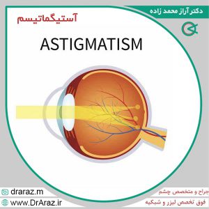 آستیگماتیسم + درمان 100% + روش های درمان دکتر آراز محمدزاده