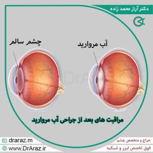 مراقبت های بعد از جراحی آب مروارید