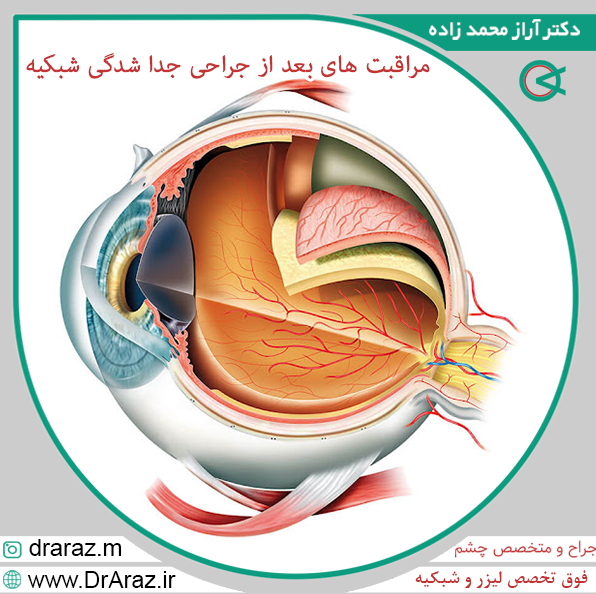عکس جراحی جداشدگی شبکیه
