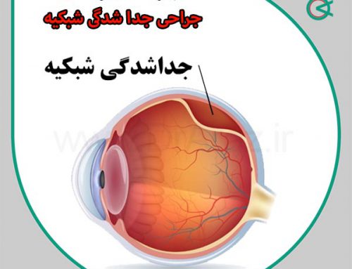 مراقبت های بعد از جراحی جدا شدگی شبکیه