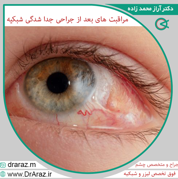 عکس جدا شدگی شبکیه - مراقبت های بعد از جراحی جداشدگی شبکیه