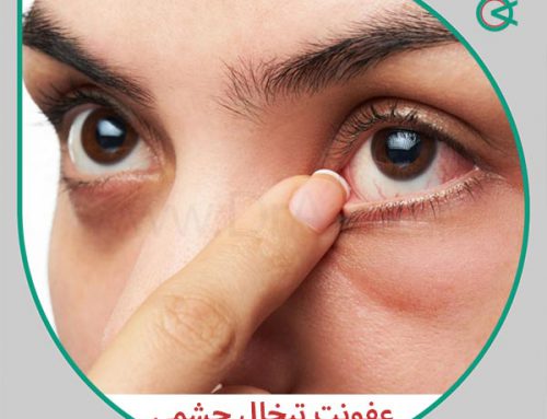 عفونت تبخال چشمی