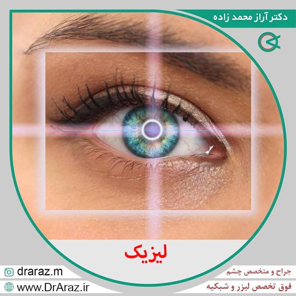 لیزیک - دکتر آراز محمدزاده