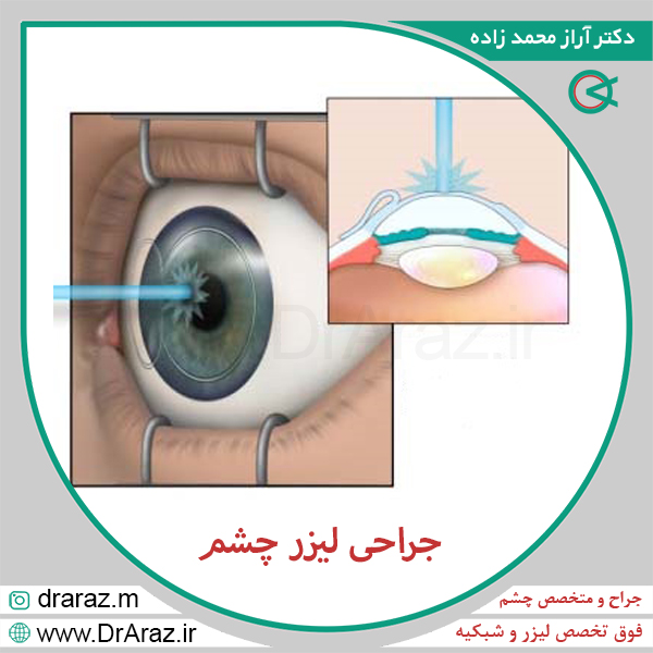 عکس جراحی لیزر چشم