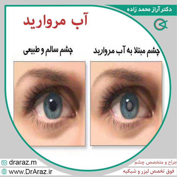 عکس آّب مروارید _ دکتر محمدزاده