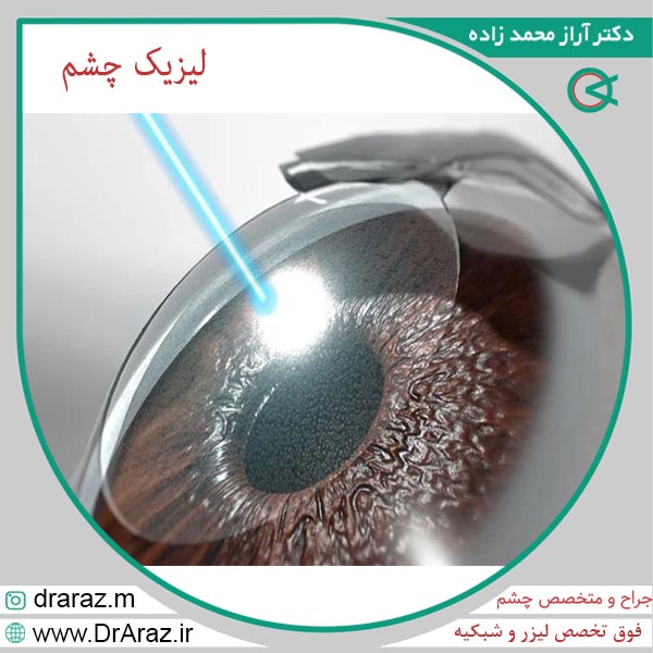 لیزیک - دکتر آراز محمدزاده