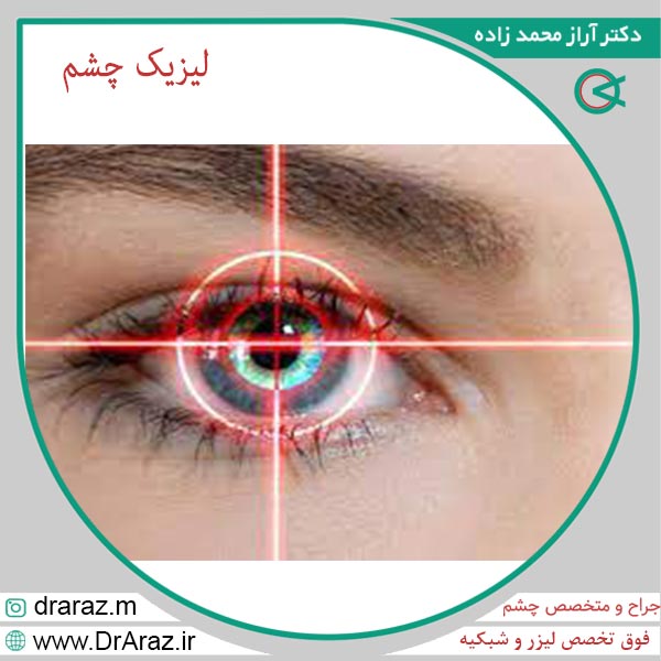 لیزیک - دکتر آراز محمدزاده