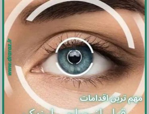 مهم ترین اقدامات قبل از جراحی لیزیک