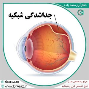عکس جدا شدگی شبکیه - دکتر آراز محمدزاده