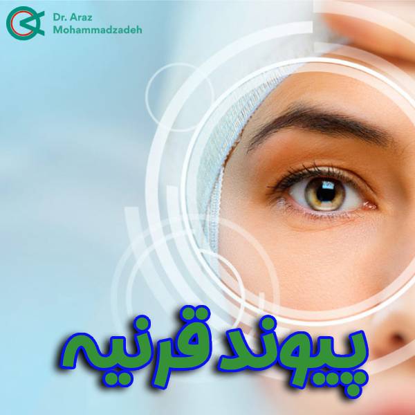 عکس پیوند قرنیه