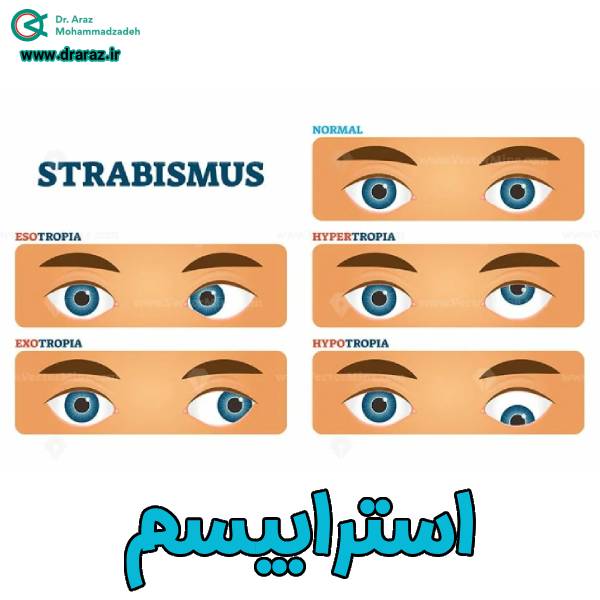 عکس انواع استرابیسم - دکتر آراز محمدزاده
