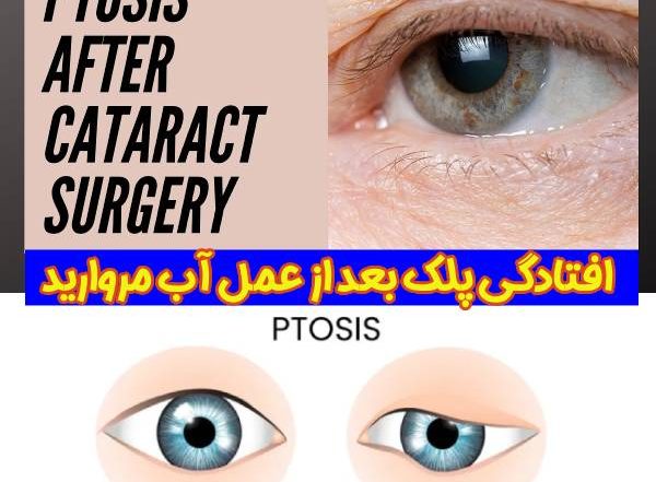 افتادگی پلک بعد از عمل آب مروارید - دکتر آراز محمدزاده