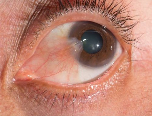 ناخنک چشم (Pterygium)