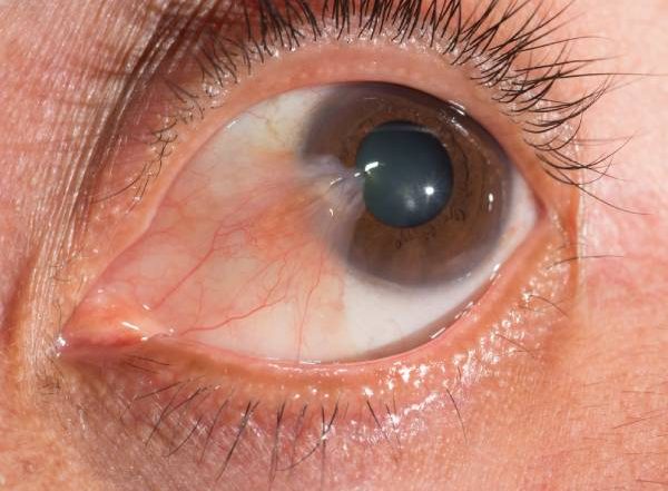 ناخنک چشم - دکتر آراز محمدزاده