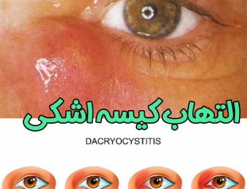 التهاب کیسه اشکی یا داکریوسیستیت