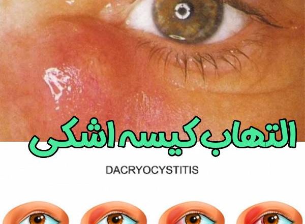 التهاب کیسه اشکی - دکتر آراز محمدزاده