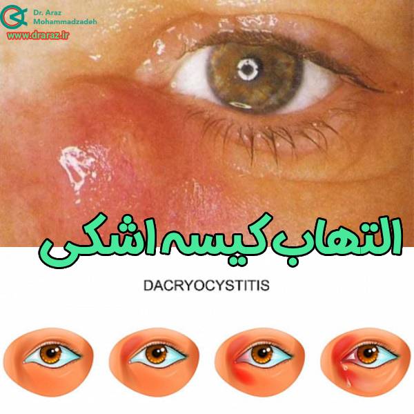 التهاب کیسه اشکی - دکتر آراز محمدزاده