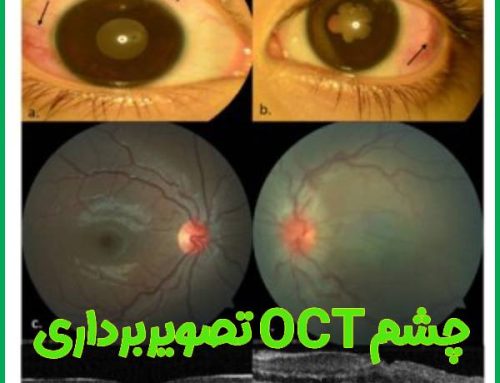 تصویربرداری OCT چشم