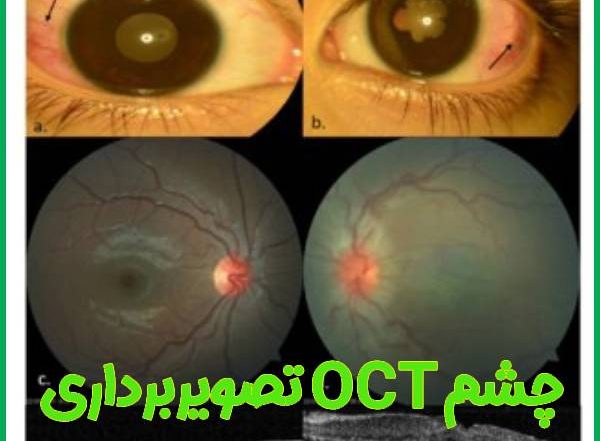 تصویربرداری او سی تی چشم - OCT - دکتر آراز محمدزاده