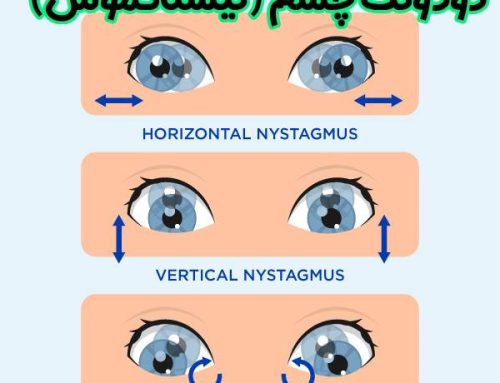 دودوئک چشم | نیستاگموس چیست ؟