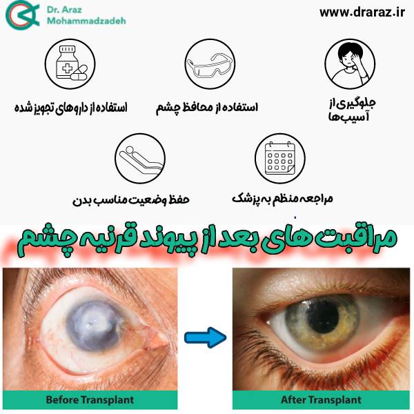 مراقبت های بعد از پیوند فرنیه چشم - دکتر آراز محمدزاده