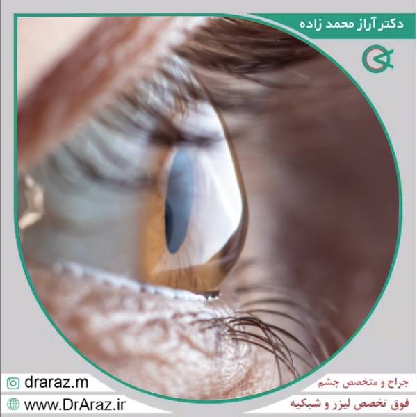 درمان آستیگماتیسم